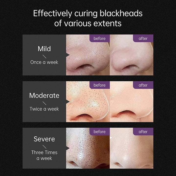 Magic Blackhead Treatment Peeling Mask
