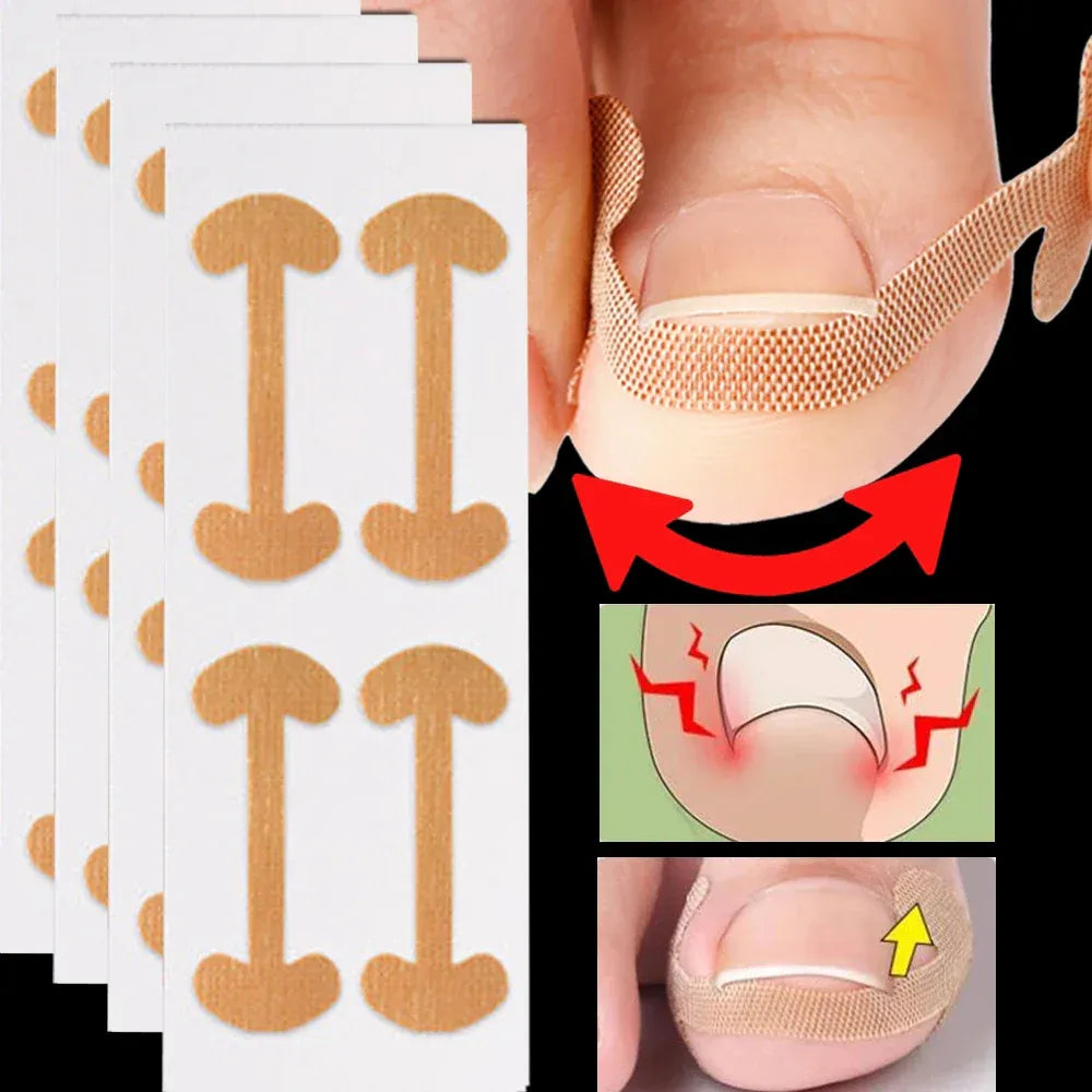 Toenail Correction Strips SET